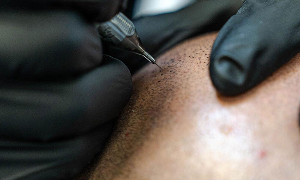 Scalp micropigmentation