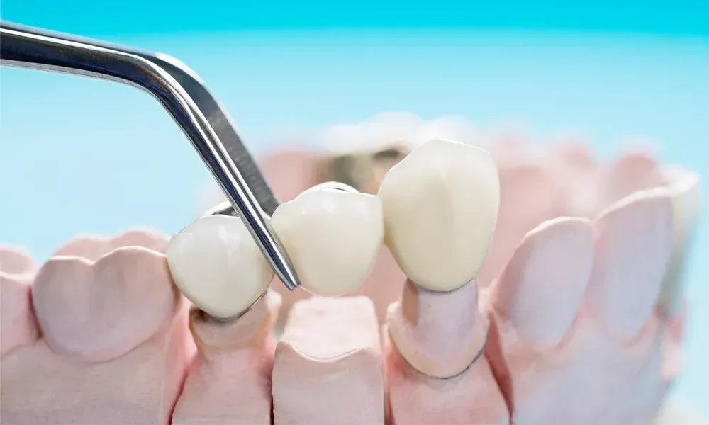 Benefits of All-on-4 Dental Implant Treatment
